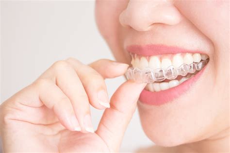 invisalign valbonne|Invisalign® Clear Aligners & Teeth Straightening.